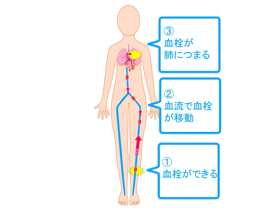エコノミークラス症候群の原因-血栓により肺塞栓を誘発
