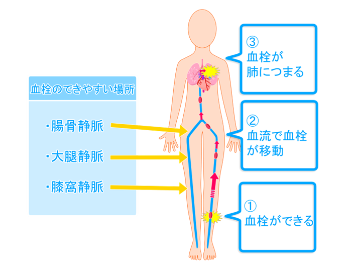 血栓のできやすい場所（深部静脈血栓症）とエコノミークラス症候群（肺塞栓症）