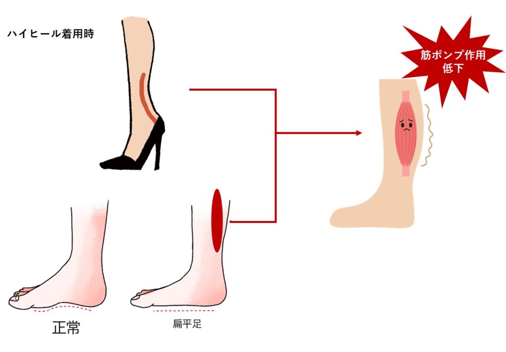 ハイヒールや偏平足によるふくらはぎの筋ポンプ作用の低下